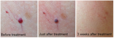 angioma before and after treatment