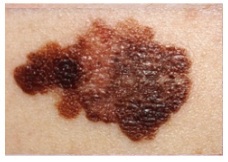 Mole checks