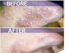 Lesion Removal Machine