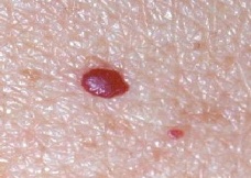 red moles